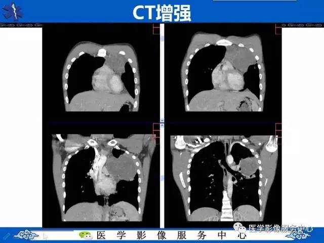 【病例】纵隔内胚窦瘤1例CT影像表现与鉴别