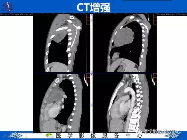 【病例】纵隔内胚窦瘤1例CT影像表现与鉴别
