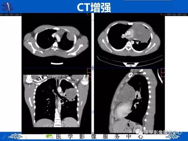 【病例】纵隔内胚窦瘤1例CT影像表现与鉴别