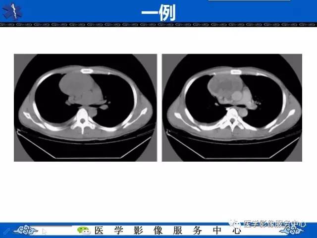 【病例】纵隔内胚窦瘤1例CT影像表现与鉴别