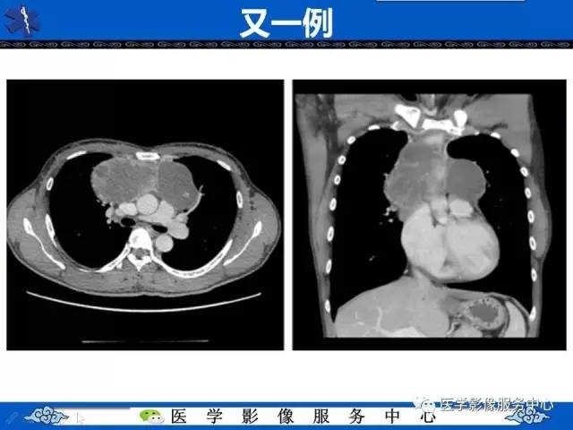【病例】纵隔内胚窦瘤1例CT影像表现与鉴别