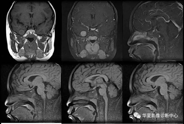 【病例】儿童颅内黄色肉芽肿1例MR影像表现