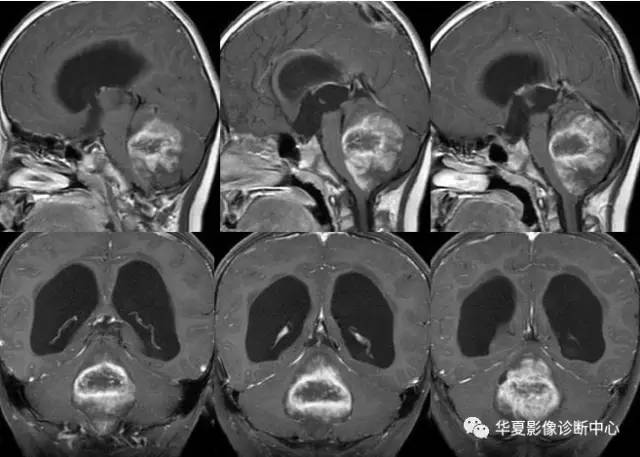 【病例】小脑少枝星形细胞瘤一例MR影像表现