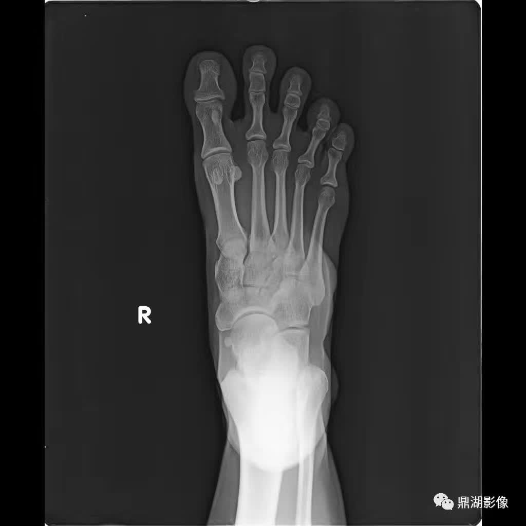 【病例】腱鞘巨细胞瘤1例X线及MR影像表现 【病例】腱鞘巨细胞瘤1例X线及MR影像表现