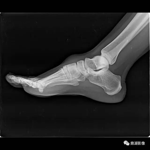 【病例】腱鞘巨细胞瘤1例X线及MR影像表现 【病例】腱鞘巨细胞瘤1例X线及MR影像表现