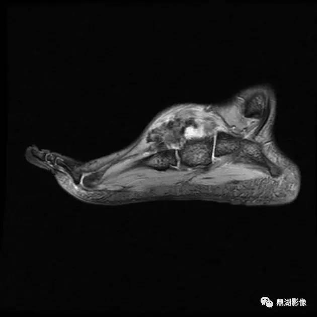 【病例】腱鞘巨细胞瘤1例X线及MR影像表现 【病例】腱鞘巨细胞瘤1例X线及MR影像表现