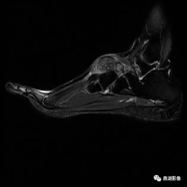 【病例】腱鞘巨细胞瘤1例X线及MR影像表现