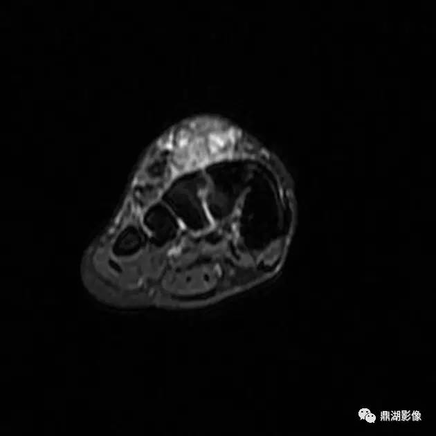 【病例】腱鞘巨细胞瘤1例X线及MR影像表现 【病例】腱鞘巨细胞瘤1例X线及MR影像表现