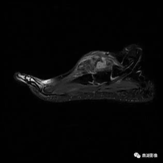 【病例】腱鞘巨细胞瘤1例X线及MR影像表现 【病例】腱鞘巨细胞瘤1例X线及MR影像表现