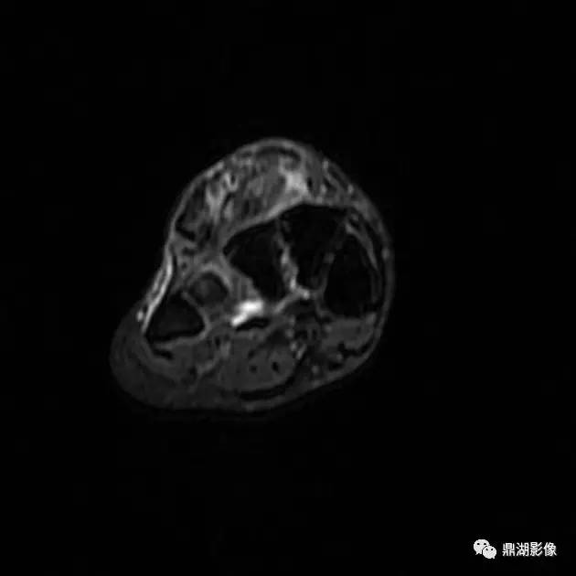 【病例】腱鞘巨细胞瘤1例X线及MR影像表现 【病例】腱鞘巨细胞瘤1例X线及MR影像表现