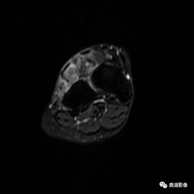 【病例】腱鞘巨细胞瘤1例X线及MR影像表现