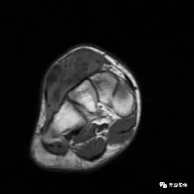 【病例】腱鞘巨细胞瘤1例X线及MR影像表现 【病例】腱鞘巨细胞瘤1例X线及MR影像表现