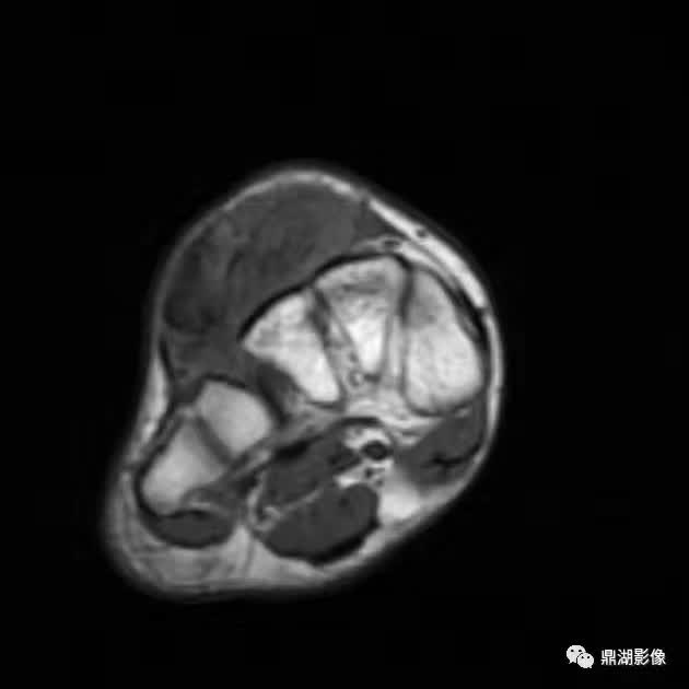 【病例】腱鞘巨细胞瘤1例X线及MR影像表现 【病例】腱鞘巨细胞瘤1例X线及MR影像表现