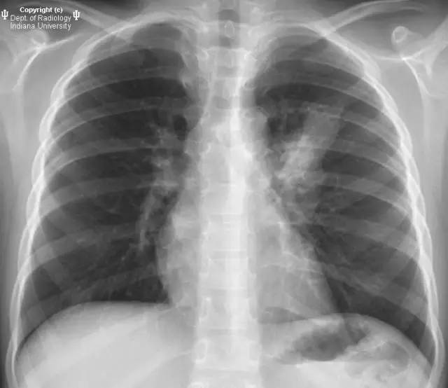 【病例】先天性囊性腺瘤样畸形1例X线CT影像表现 【病例】先天性囊性腺瘤样畸形1例X线CT影像表现