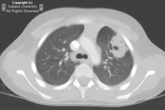 【病例】先天性囊性腺瘤样畸形1例X线CT影像表现