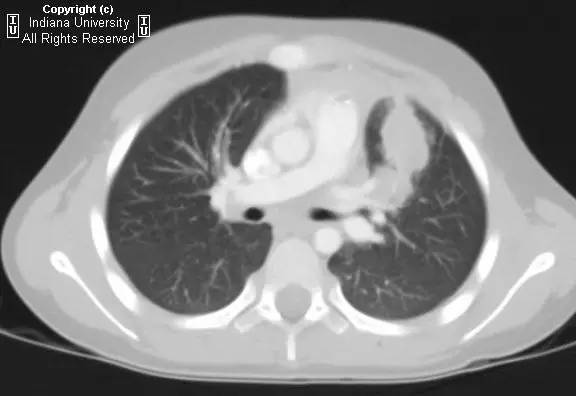 【病例】先天性囊性腺瘤样畸形1例X线CT影像表现 【病例】先天性囊性腺瘤样畸形1例X线CT影像表现