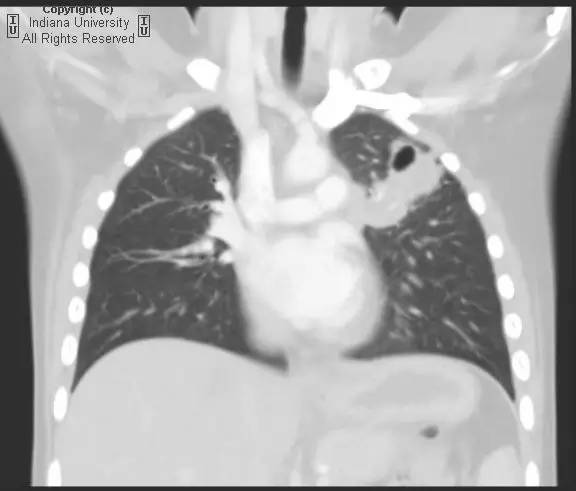 【病例】先天性囊性腺瘤样畸形1例X线CT影像表现 【病例】先天性囊性腺瘤样畸形1例X线CT影像表现