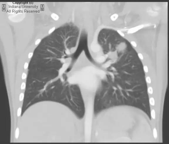 【病例】先天性囊性腺瘤样畸形1例X线CT影像表现 【病例】先天性囊性腺瘤样畸形1例X线CT影像表现
