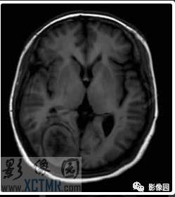 【病例】右枕部血管周细胞瘤1例MR影像表现 【病例】右枕部血管周细胞瘤1例MR影像表现