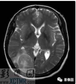 【病例】右枕部血管周细胞瘤1例MR影像表现