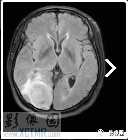 【病例】右枕部血管周细胞瘤1例MR影像表现 【病例】右枕部血管周细胞瘤1例MR影像表现