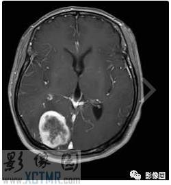 【病例】右枕部血管周细胞瘤1例MR影像表现 【病例】右枕部血管周细胞瘤1例MR影像表现