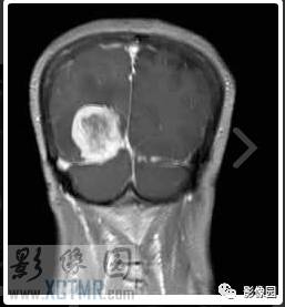【病例】右枕部血管周细胞瘤1例MR影像表现 【病例】右枕部血管周细胞瘤1例MR影像表现