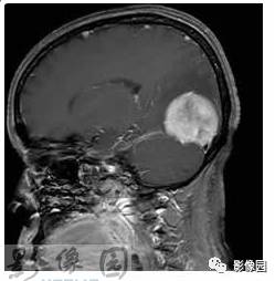 【病例】右枕部血管周细胞瘤1例MR影像表现 【病例】右枕部血管周细胞瘤1例MR影像表现