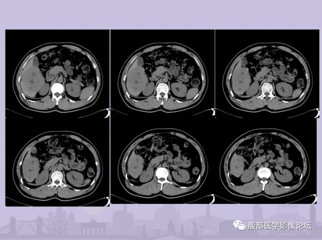 【误诊病例】肝脏孤立性坏死结节1例CT及MR影像表现