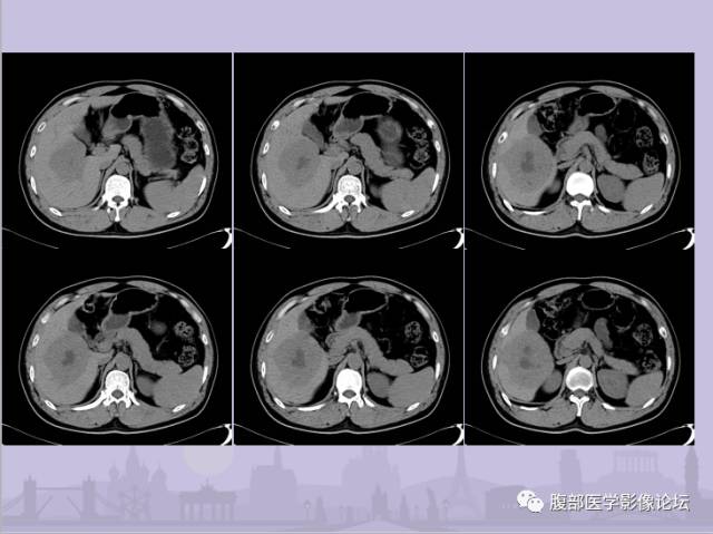 【误诊病例】肝脏孤立性坏死结节1例CT及MR影像表现