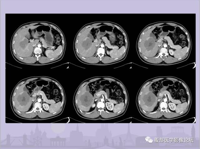 【误诊病例】肝脏孤立性坏死结节1例CT及MR影像表现