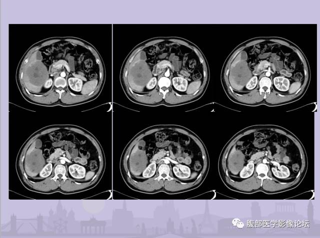 【误诊病例】肝脏孤立性坏死结节1例CT及MR影像表现