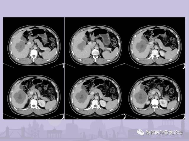 【误诊病例】肝脏孤立性坏死结节1例CT及MR影像表现