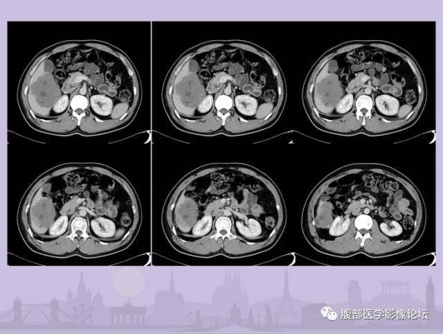 【误诊病例】肝脏孤立性坏死结节1例CT及MR影像表现