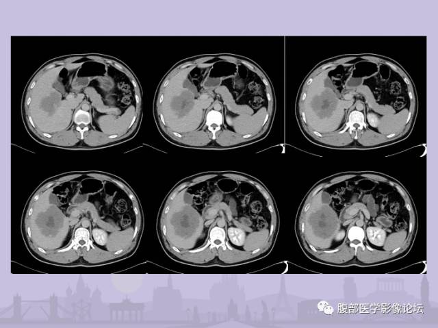 【误诊病例】肝脏孤立性坏死结节1例CT及MR影像表现