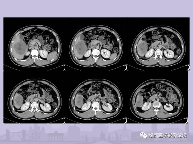 【误诊病例】肝脏孤立性坏死结节1例CT及MR影像表现