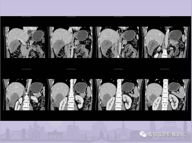 【误诊病例】肝脏孤立性坏死结节1例CT及MR影像表现