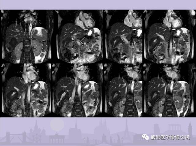 【误诊病例】肝脏孤立性坏死结节1例CT及MR影像表现