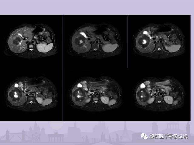 【误诊病例】肝脏孤立性坏死结节1例CT及MR影像表现