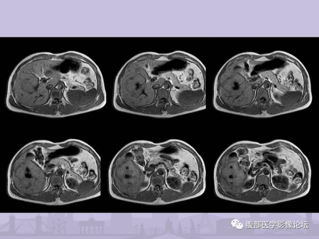 【误诊病例】肝脏孤立性坏死结节1例CT及MR影像表现