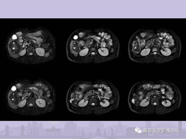 【误诊病例】肝脏孤立性坏死结节1例CT及MR影像表现