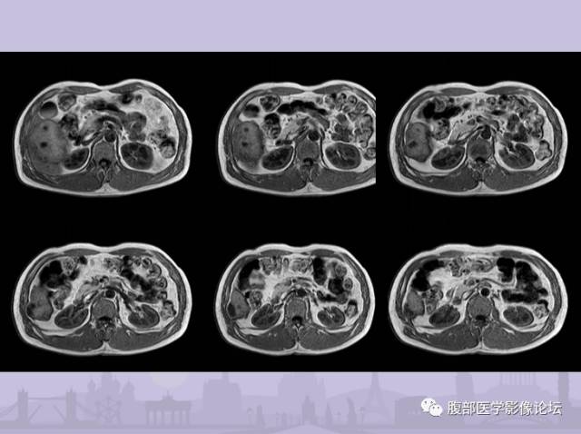【误诊病例】肝脏孤立性坏死结节1例CT及MR影像表现