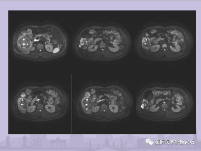 【误诊病例】肝脏孤立性坏死结节1例CT及MR影像表现