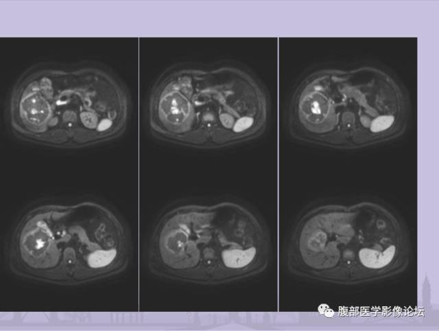【误诊病例】肝脏孤立性坏死结节1例CT及MR影像表现