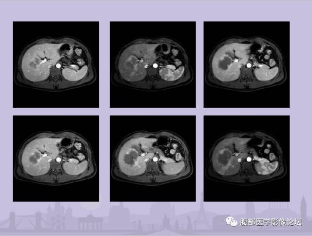 【误诊病例】肝脏孤立性坏死结节1例CT及MR影像表现