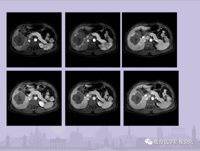【误诊病例】肝脏孤立性坏死结节1例CT及MR影像表现
