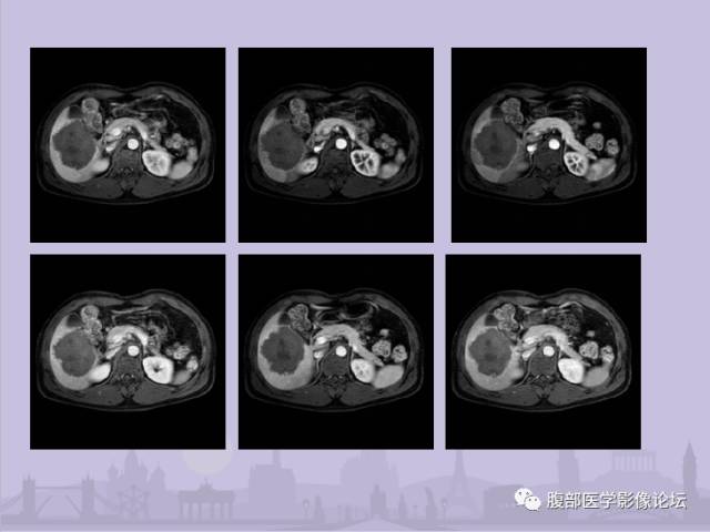 【误诊病例】肝脏孤立性坏死结节1例CT及MR影像表现