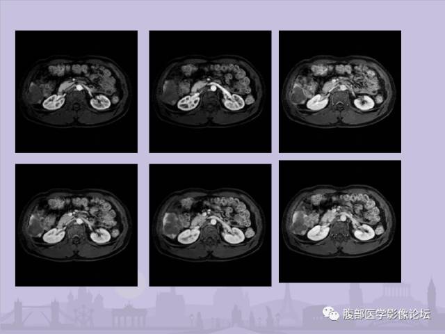 【误诊病例】肝脏孤立性坏死结节1例CT及MR影像表现