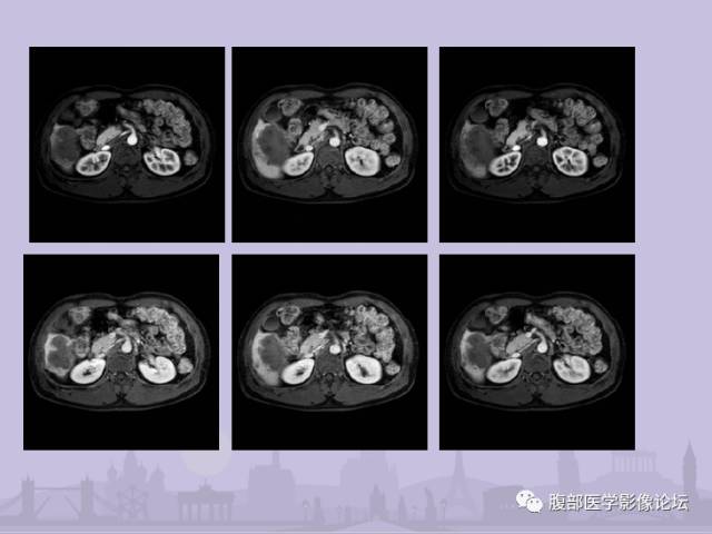 【误诊病例】肝脏孤立性坏死结节1例CT及MR影像表现