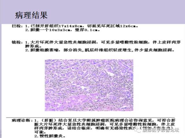 【误诊病例】肝脏孤立性坏死结节1例CT及MR影像表现
